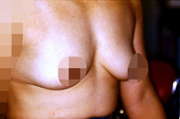 授乳終了で垂れた胸には乳房固定か？バックによる豊胸術か？