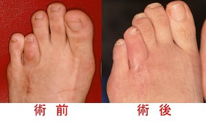 第Ⅳ趾短縮症とは 第Ⅳ趾短縮症とは