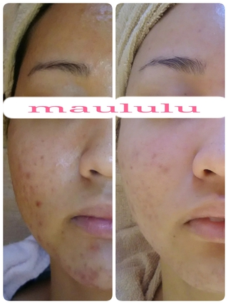 フォトフェイシャル(before after) フォトフェイシャル(before after)