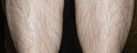 (^^)/ Before→After メンズ脱毛 (^^)/ Before→After メンズ脱毛