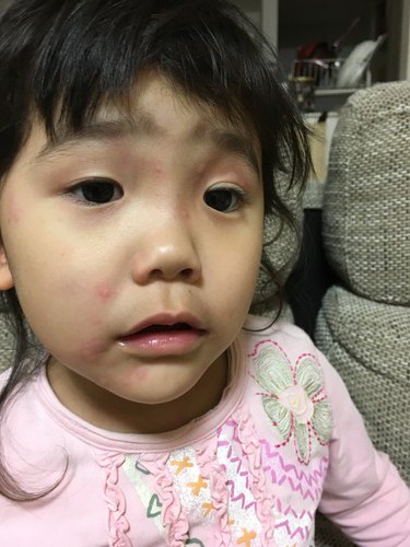 【アレルギー？】全身に謎の蕁麻疹がでて凄く痒そうで可哀想。血液検査結果待ちです。
