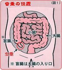 急性虫垂炎（盲腸）について