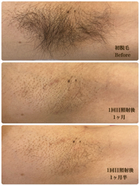 男性モニター様　照射1回目 2023/03/10 08:46:11