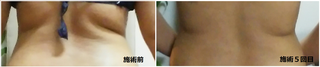 施術５回目で背中肉が・・・！