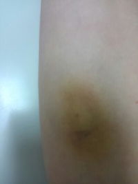 点滴跡が・・・ 2015/07/13 09:34:29