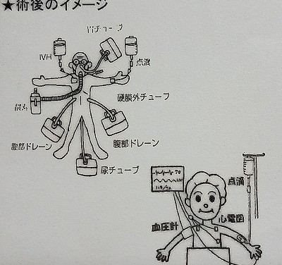 盲腸がん（大腸がん）　入院から手術　その翌日まで