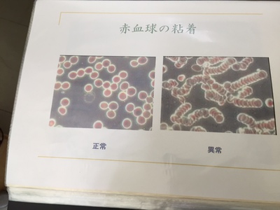 血流障害が身の破滅