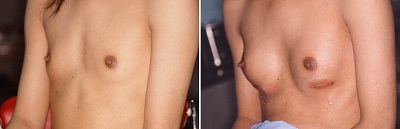美容外科のまもる君 男性の豊胸術
