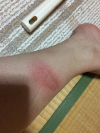 火傷 2014/11/14 19:36:59