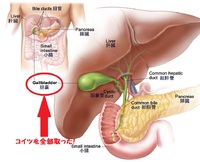胆嚢（たんのう）を摘出して人生が劇的に変わった男の話を少々！