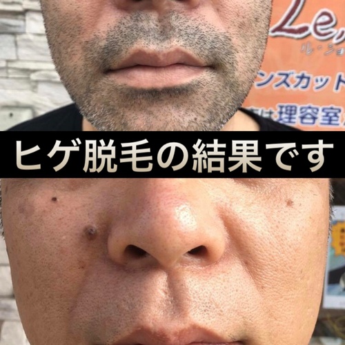 ヒゲ脱毛