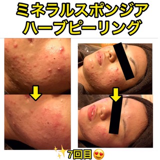 大人気 ハーブピーリング 毛穴撲滅 ニキビケア ハーブピーリング専門店 Cell セル