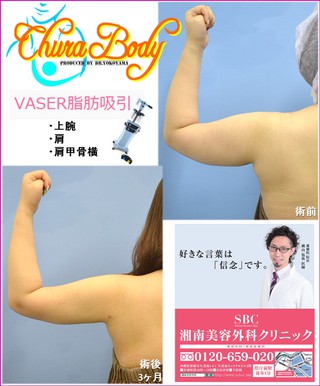 ああ、憧れのスッキリ二の腕