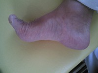 足底腱膜炎・足底筋膜炎　その１