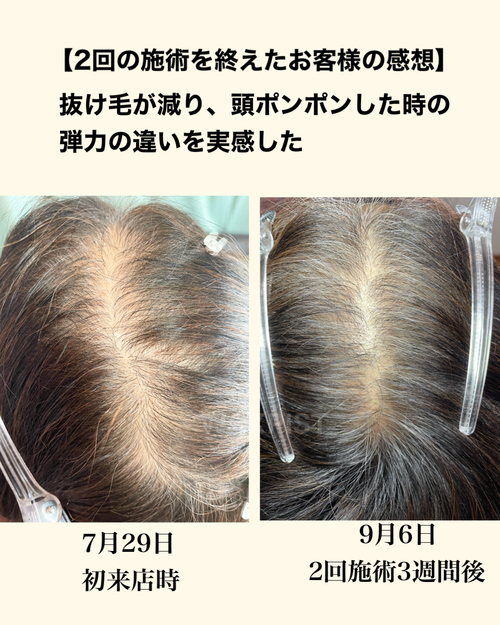 薄毛対策 ワックス脱毛と薄毛お悩み解消へ導くブログ:薄毛改善！！！